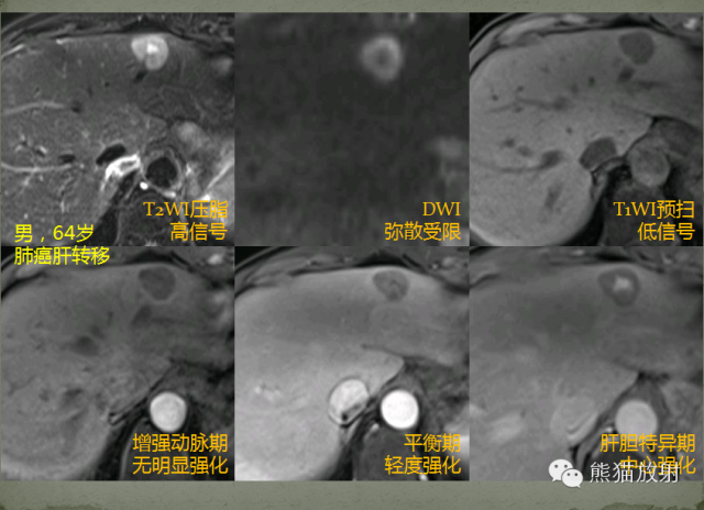 影像PPT - 肝脏T2高信号中心瘢痕病变的鉴别诊断-9