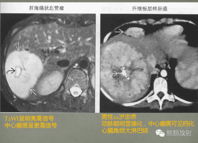 影像PPT - 肝脏T2高信号中心瘢痕病变的鉴别诊断-15