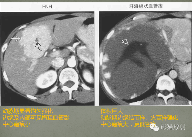 影像PPT - 肝脏T2高信号中心瘢痕病变的鉴别诊断-14