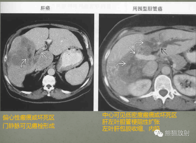 影像PPT - 肝脏T2高信号中心瘢痕病变的鉴别诊断-16