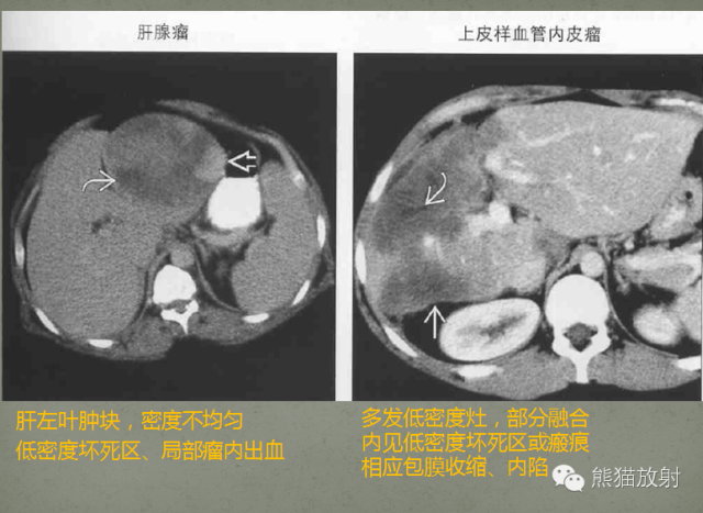 影像PPT - 肝脏T2高信号中心瘢痕病变的鉴别诊断-17