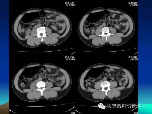 影像PPT - 【病例】成人型先天性巨结肠1例X线及CT-1