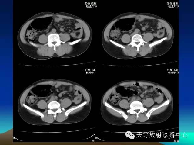 影像PPT - 【病例】成人型先天性巨结肠1例X线及CT-2