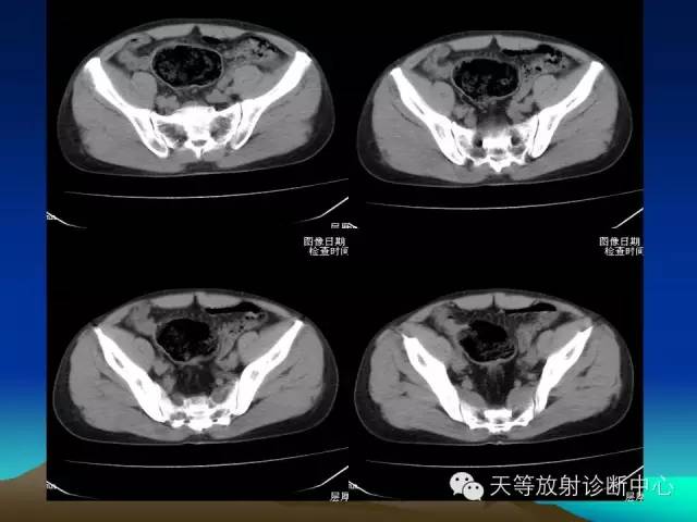 影像PPT - 【病例】成人型先天性巨结肠1例X线及CT-4