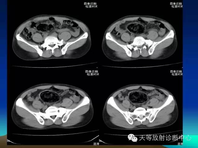 影像PPT - 【病例】成人型先天性巨结肠1例X线及CT-3