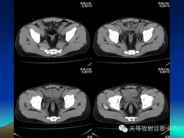 影像PPT - 【病例】成人型先天性巨结肠1例X线及CT-5