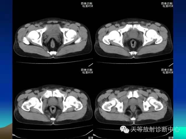 影像PPT - 【病例】成人型先天性巨结肠1例X线及CT-6