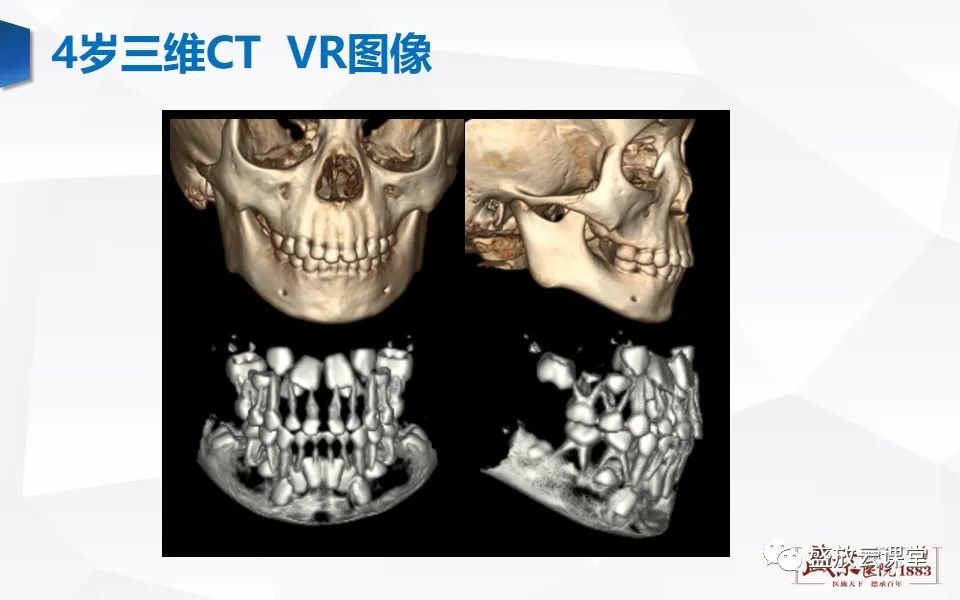 影像PPT - 【PPT】儿童牙齿的解剖和变异-10