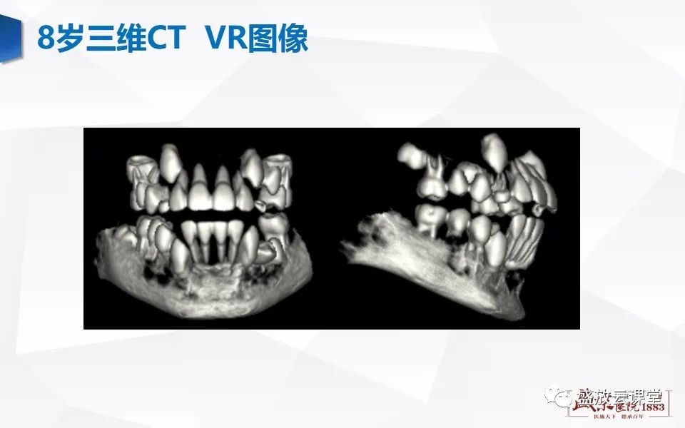 影像PPT - 【PPT】儿童牙齿的解剖和变异-12