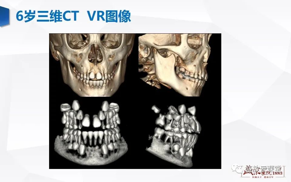 影像PPT - 【PPT】儿童牙齿的解剖和变异-11