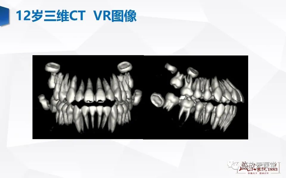 影像PPT - 【PPT】儿童牙齿的解剖和变异-13
