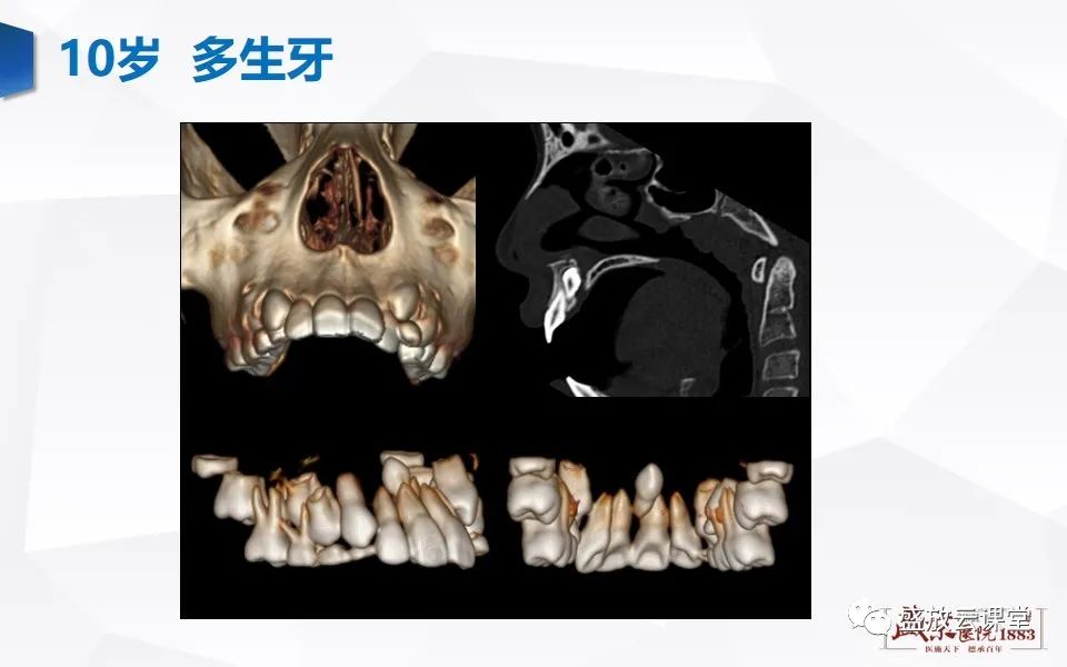 影像PPT - 【PPT】儿童牙齿的解剖和变异-18