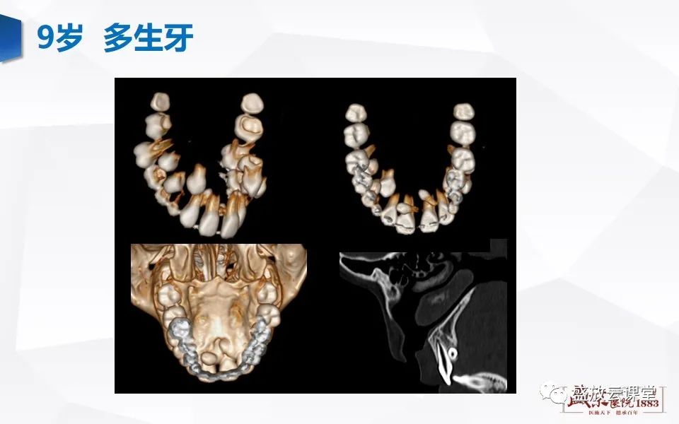 影像PPT - 【PPT】儿童牙齿的解剖和变异-17