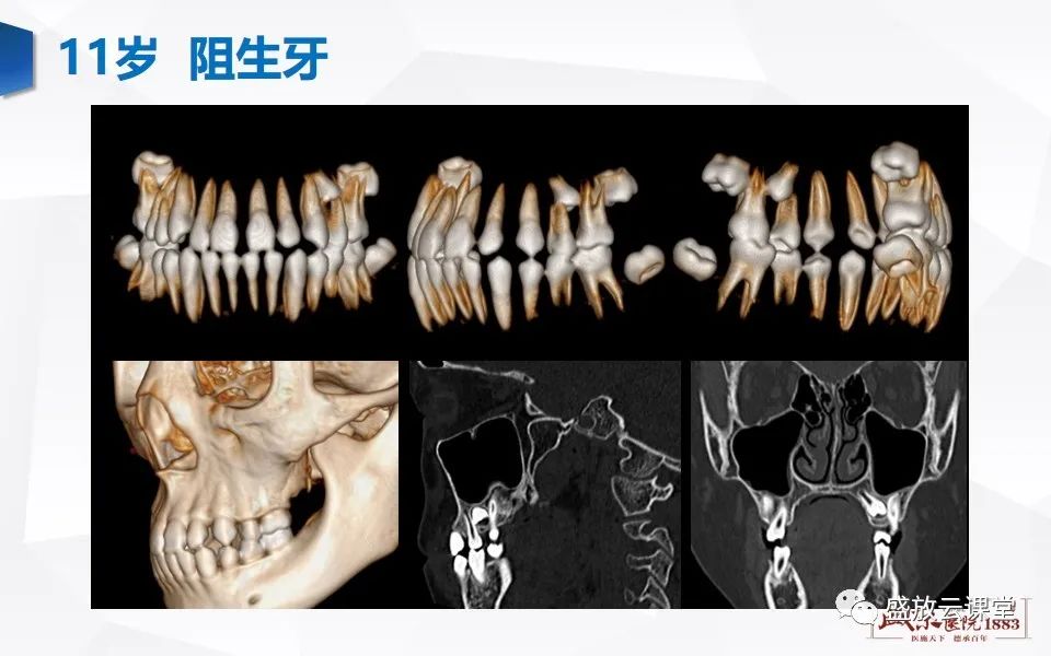 影像PPT - 【PPT】儿童牙齿的解剖和变异-19