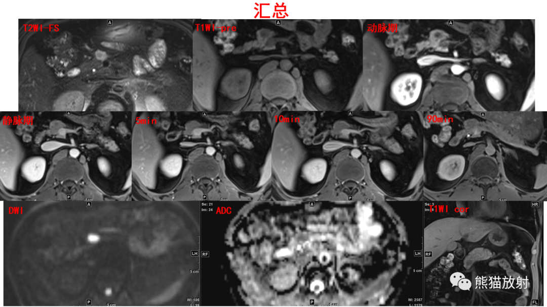 影像PPT - 【PPT】胰腺实性假乳头状瘤1例MR-17