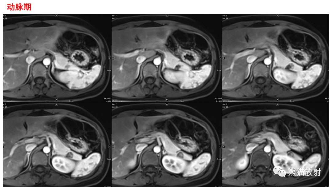 影像PPT - 【PPT】胰腺实性假乳头状瘤1例MR-27