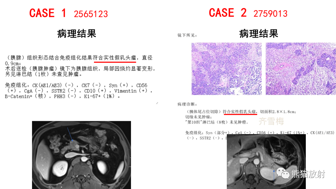 影像PPT - 【PPT】胰腺实性假乳头状瘤1例MR-36