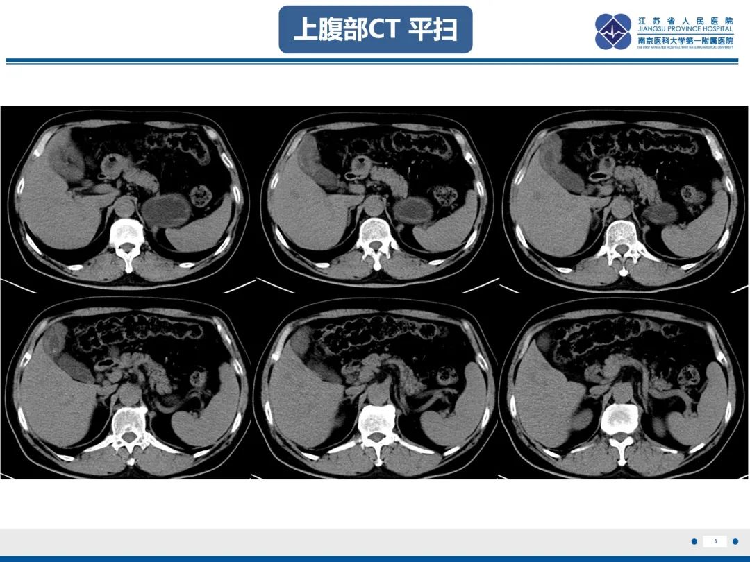 影像PPT - 【PPT】胆囊腺肌症-4
