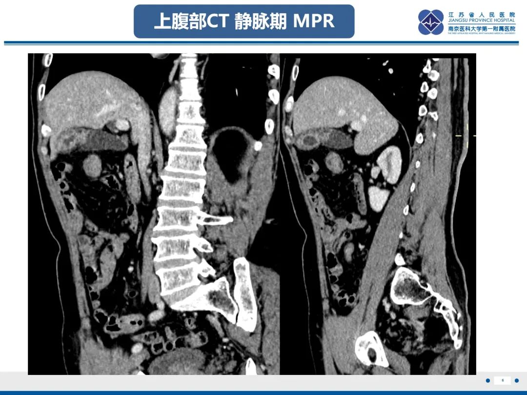 影像PPT - 【PPT】胆囊腺肌症-7