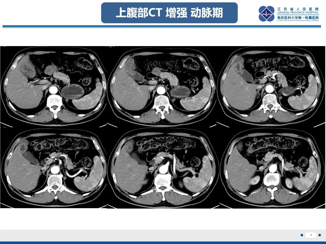 影像PPT - 【PPT】胆囊腺肌症-5