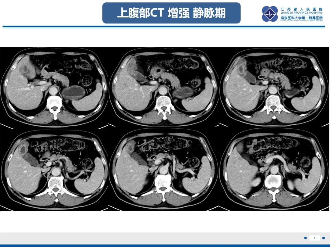 影像PPT - 【PPT】胆囊腺肌症-6