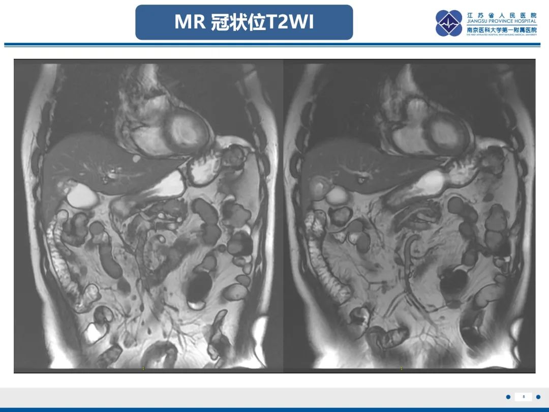 影像PPT - 【PPT】胆囊腺肌症-9