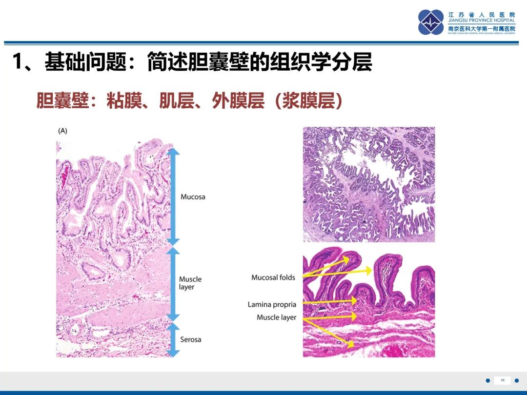 影像PPT - 【PPT】胆囊腺肌症-12