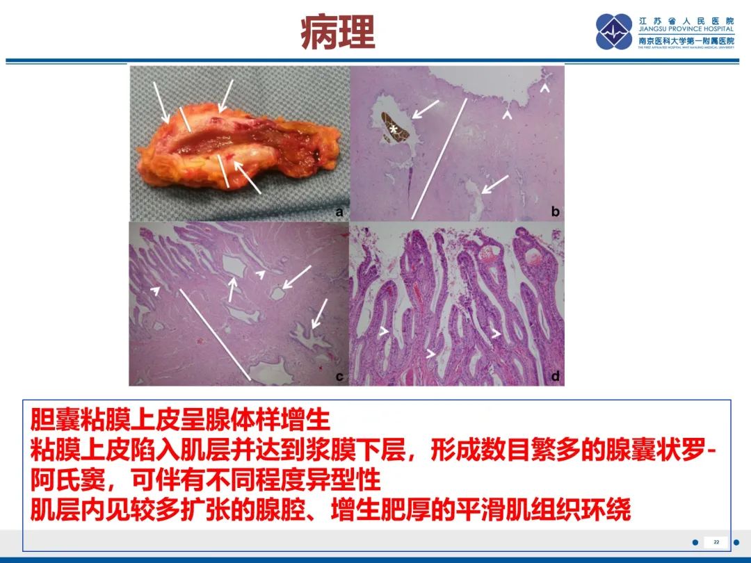 影像PPT - 【PPT】胆囊腺肌症-23
