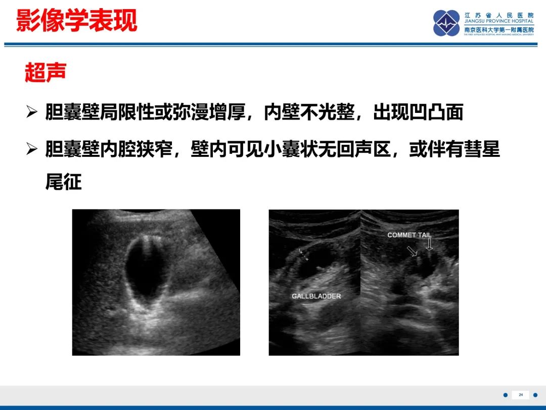 影像PPT - 【PPT】胆囊腺肌症-25