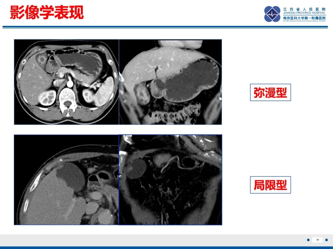 影像PPT - 【PPT】胆囊腺肌症-27