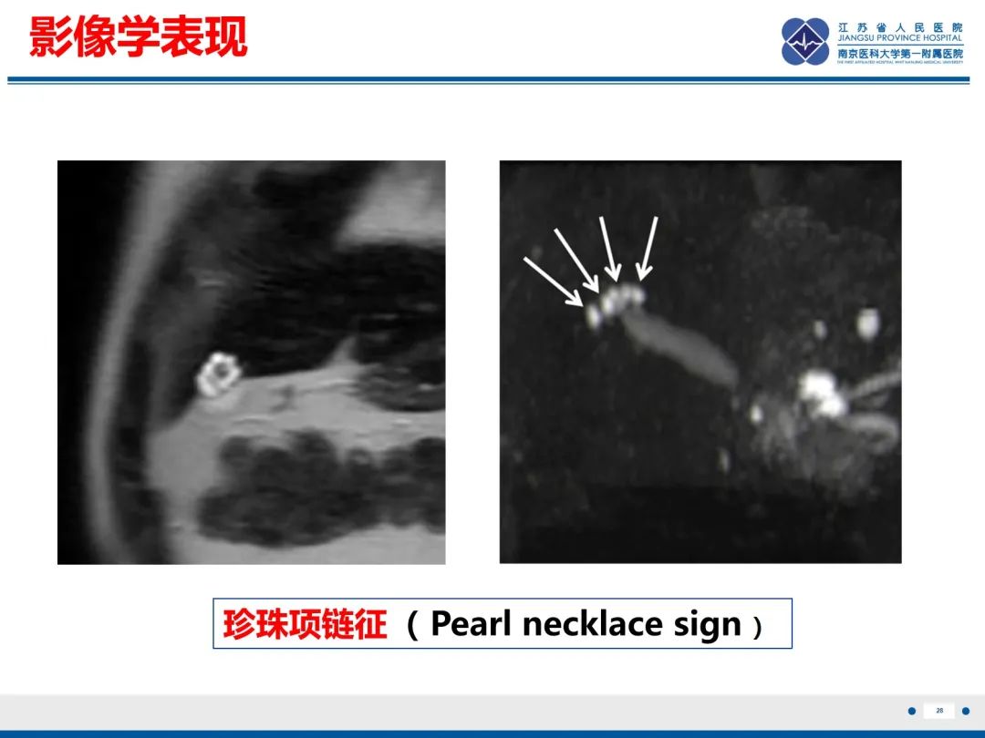 影像PPT - 【PPT】胆囊腺肌症-29