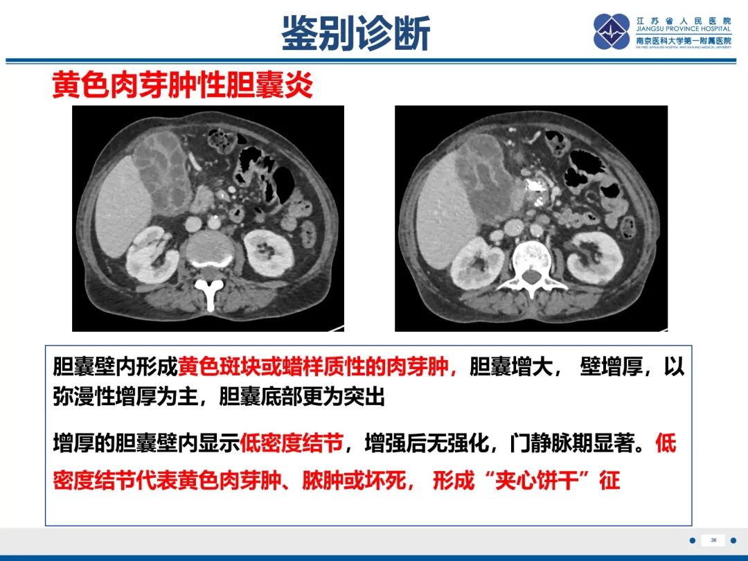 影像PPT - 【PPT】胆囊腺肌症-37