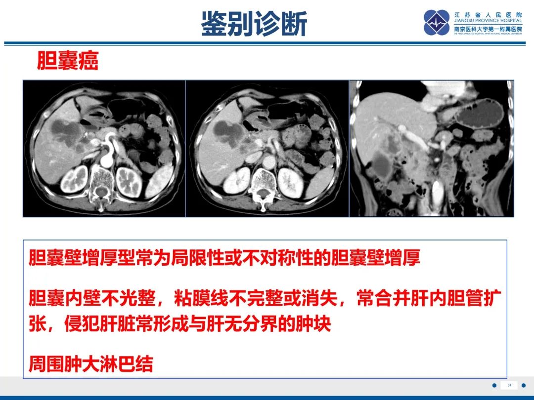 影像PPT - 【PPT】胆囊腺肌症-38
