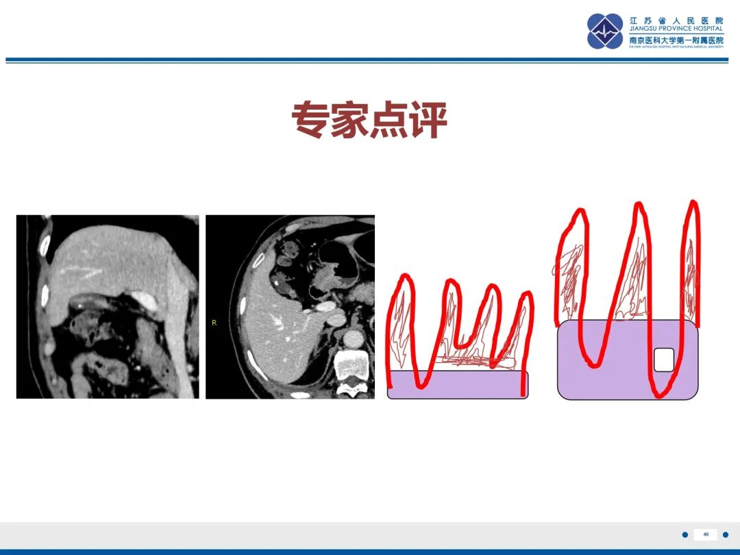 影像PPT - 【PPT】胆囊腺肌症-41