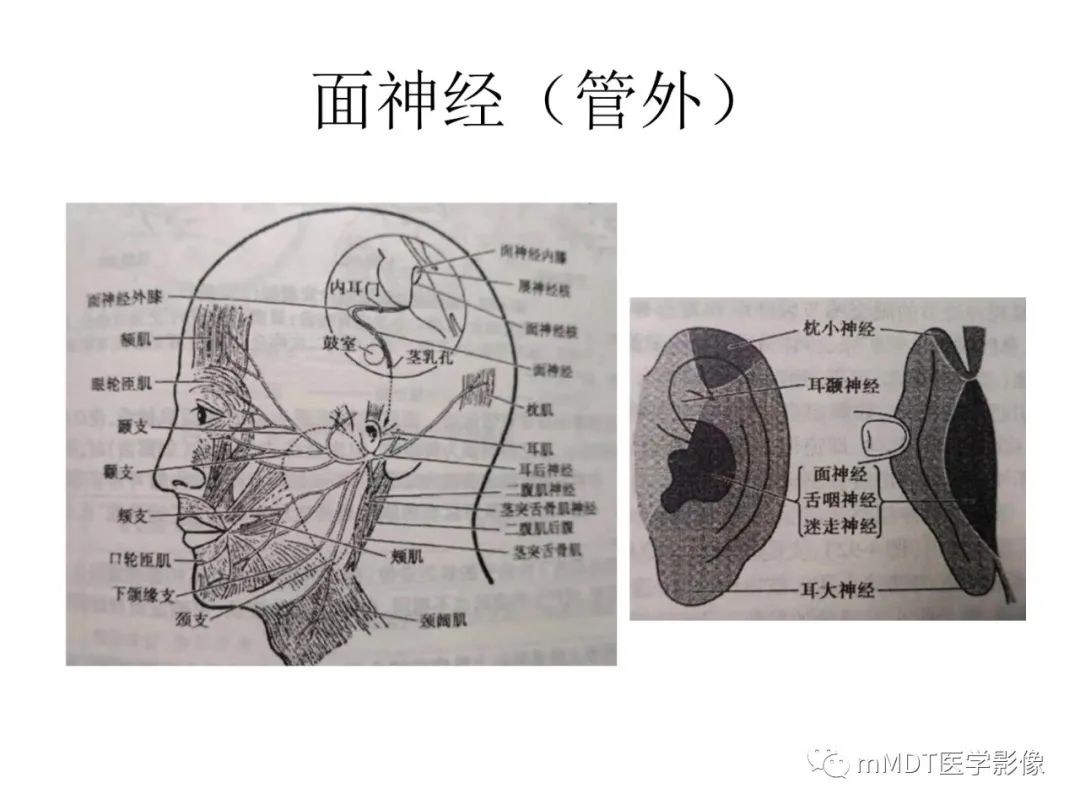 影像PPT - 【PPT】行走在孔道里的面神经-10