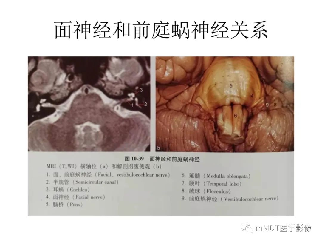 影像PPT - 【PPT】行走在孔道里的面神经-20