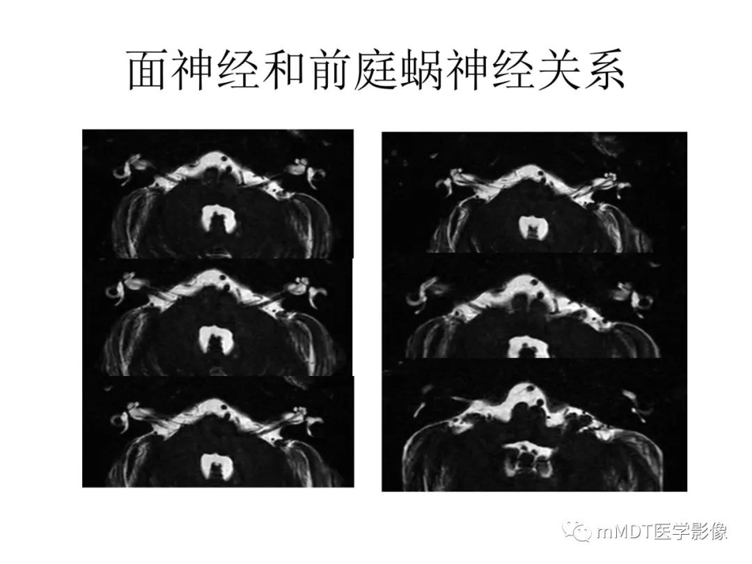 影像PPT - 【PPT】行走在孔道里的面神经-21