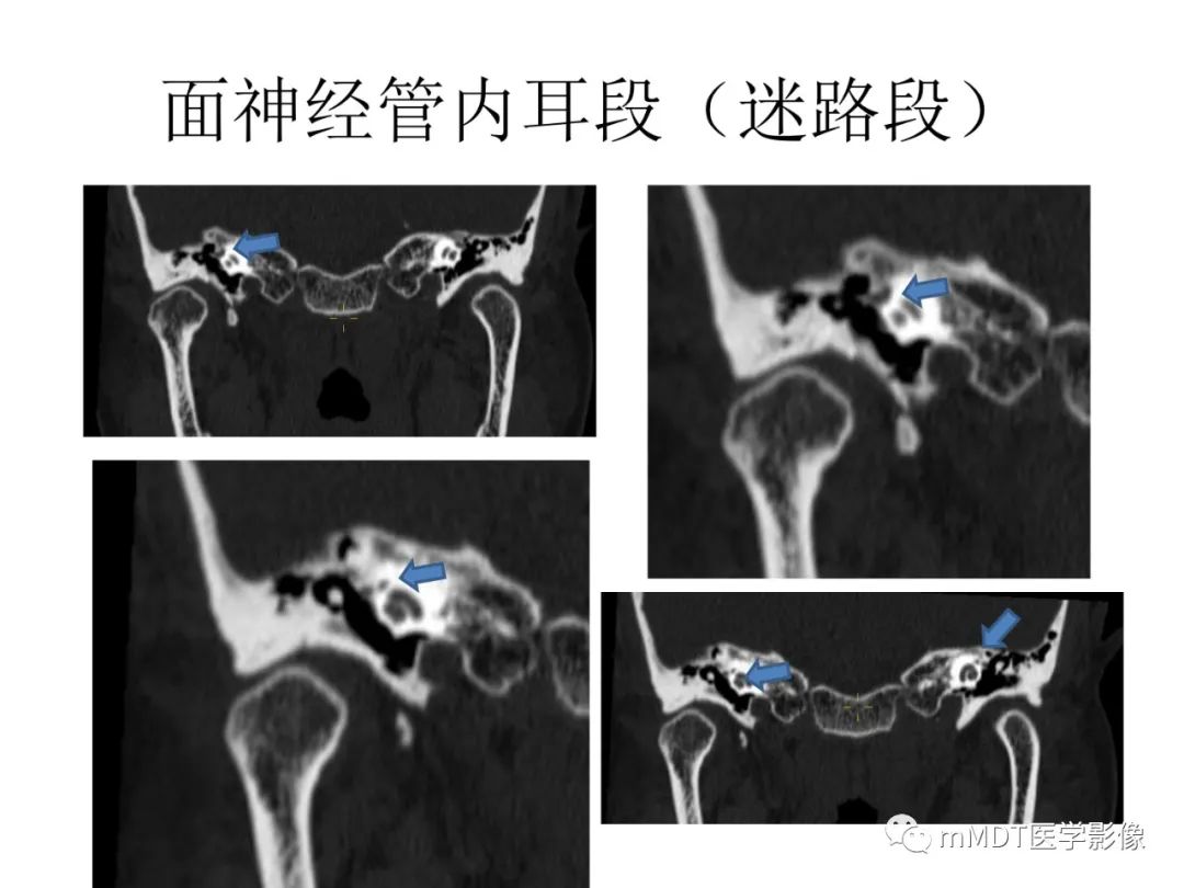 影像PPT - 【PPT】行走在孔道里的面神经-28