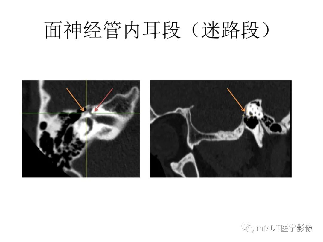 影像PPT - 【PPT】行走在孔道里的面神经-31