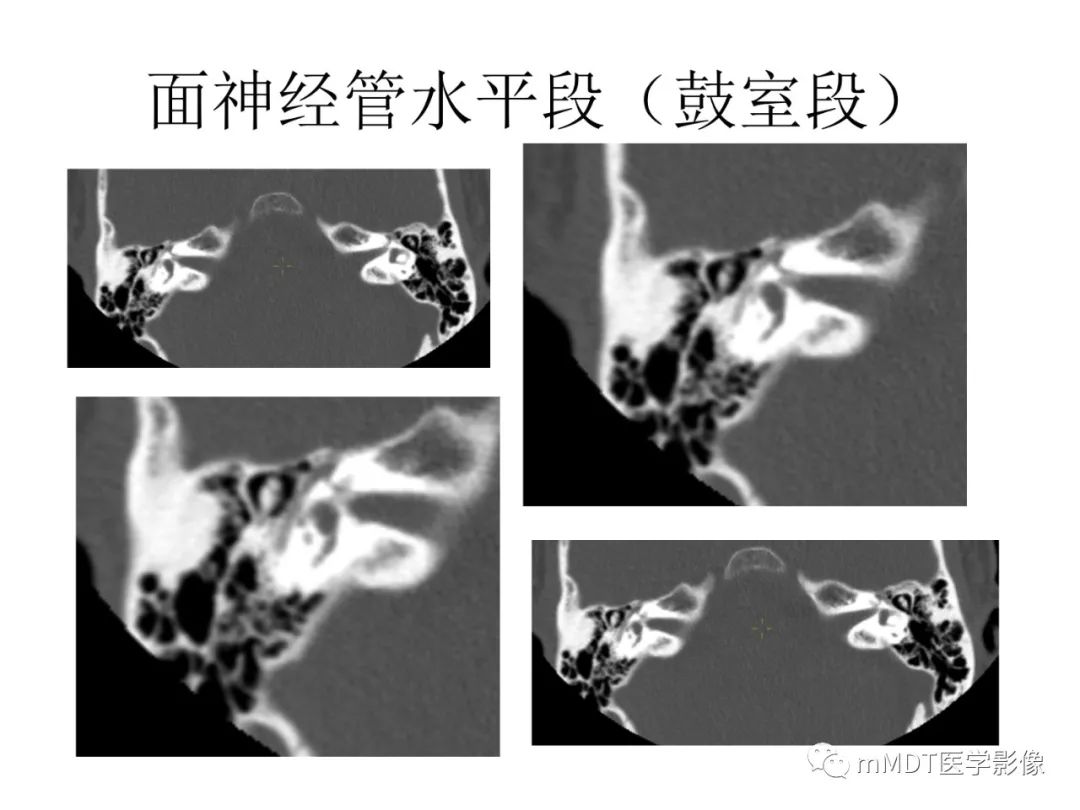 影像PPT - 【PPT】行走在孔道里的面神经-32