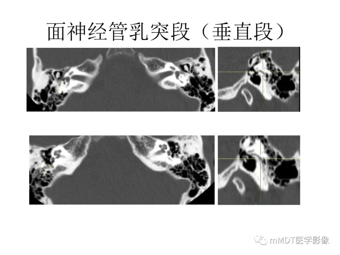 影像PPT - 【PPT】行走在孔道里的面神经-37