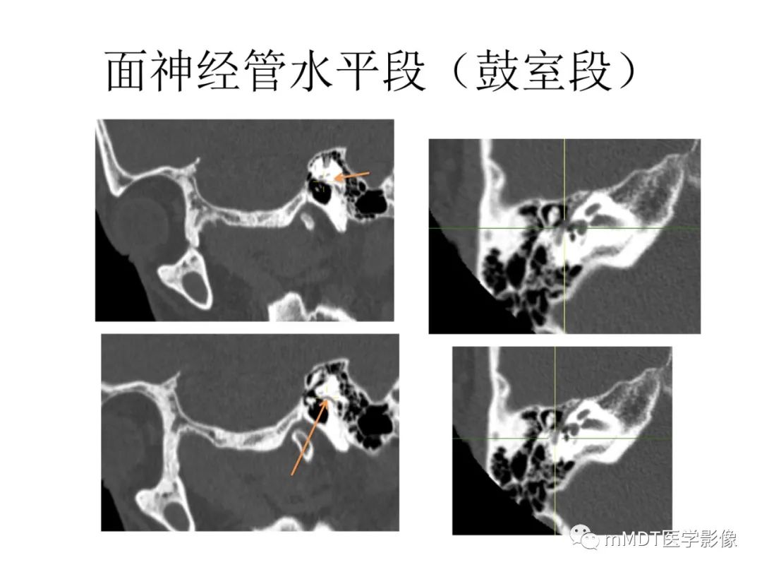影像PPT - 【PPT】行走在孔道里的面神经-36