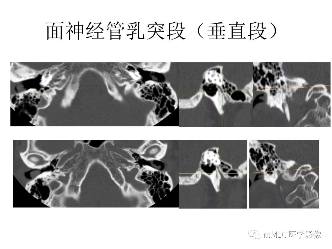 影像PPT - 【PPT】行走在孔道里的面神经-38