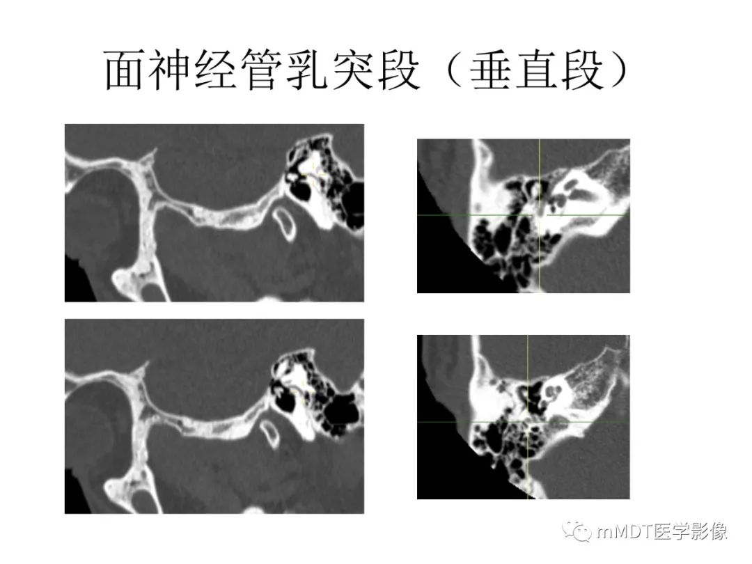 影像PPT - 【PPT】行走在孔道里的面神经-41