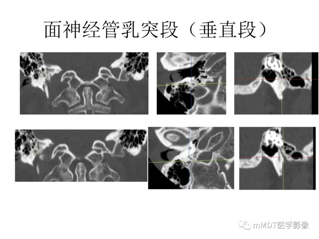 影像PPT - 【PPT】行走在孔道里的面神经-40