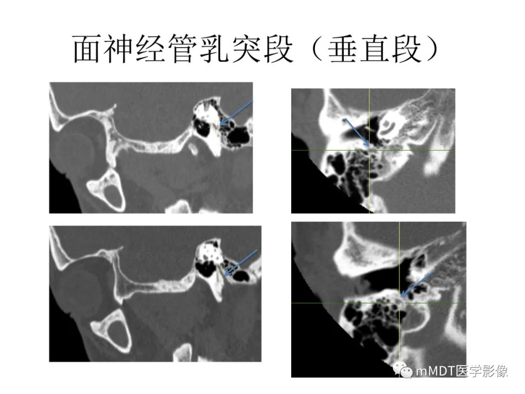 影像PPT - 【PPT】行走在孔道里的面神经-43