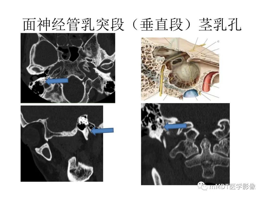 影像PPT - 【PPT】行走在孔道里的面神经-44