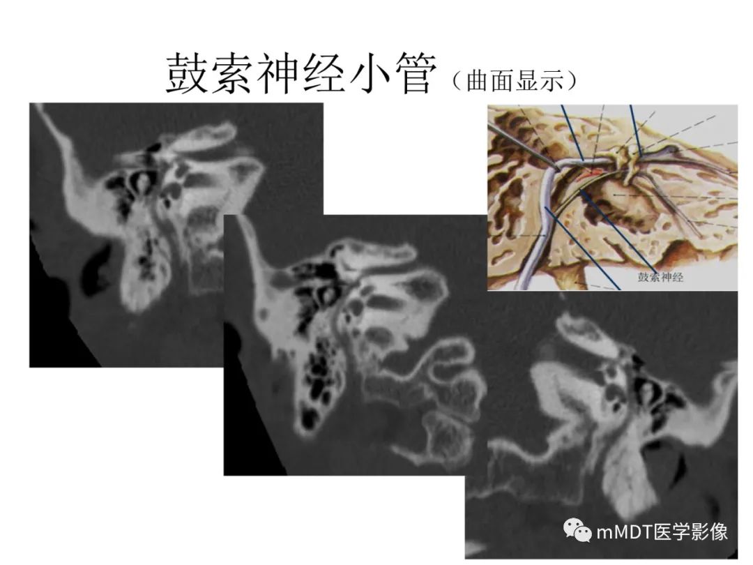 影像PPT - 【PPT】行走在孔道里的面神经-48