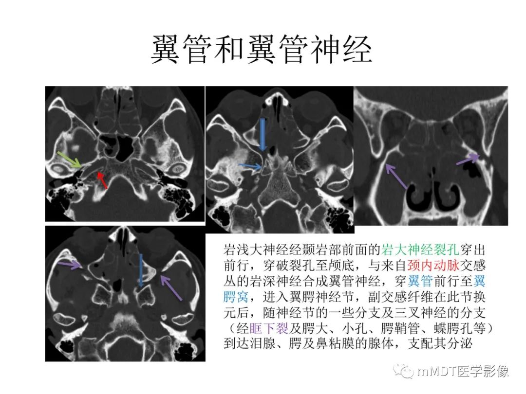 影像PPT - 【PPT】行走在孔道里的面神经-53