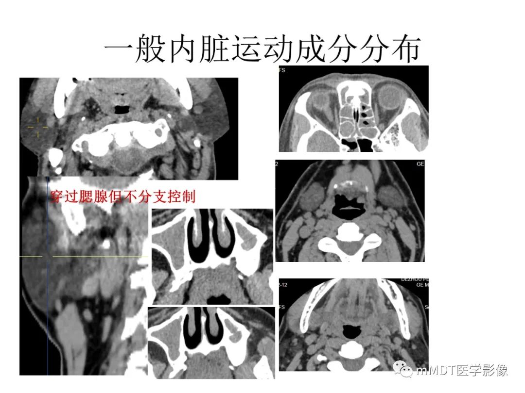 影像PPT - 【PPT】行走在孔道里的面神经-56